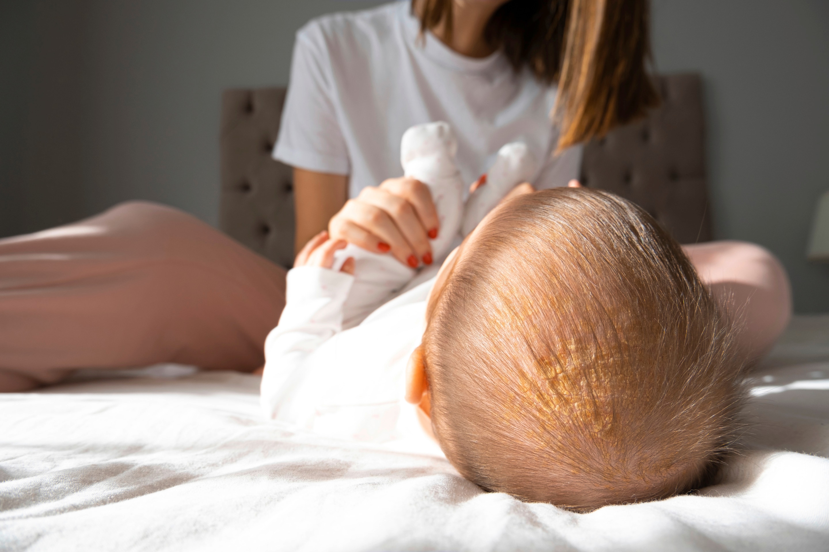 kulit kepala bayi yang menunjukkan cradle cap saat berbaring bersama ibunya di tempat tidur
