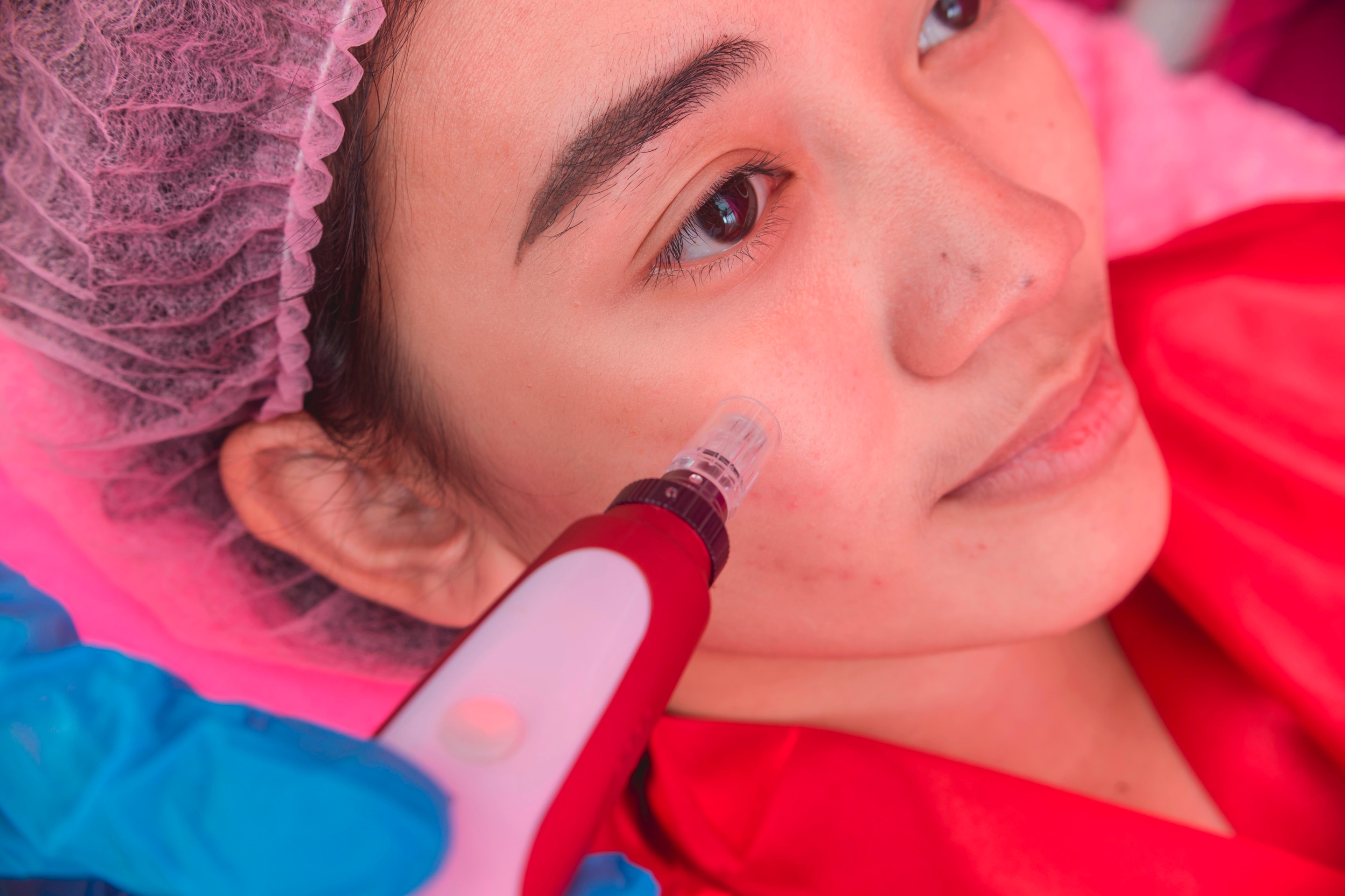 Close-up of Asian girl getting microneedling treatment on face.