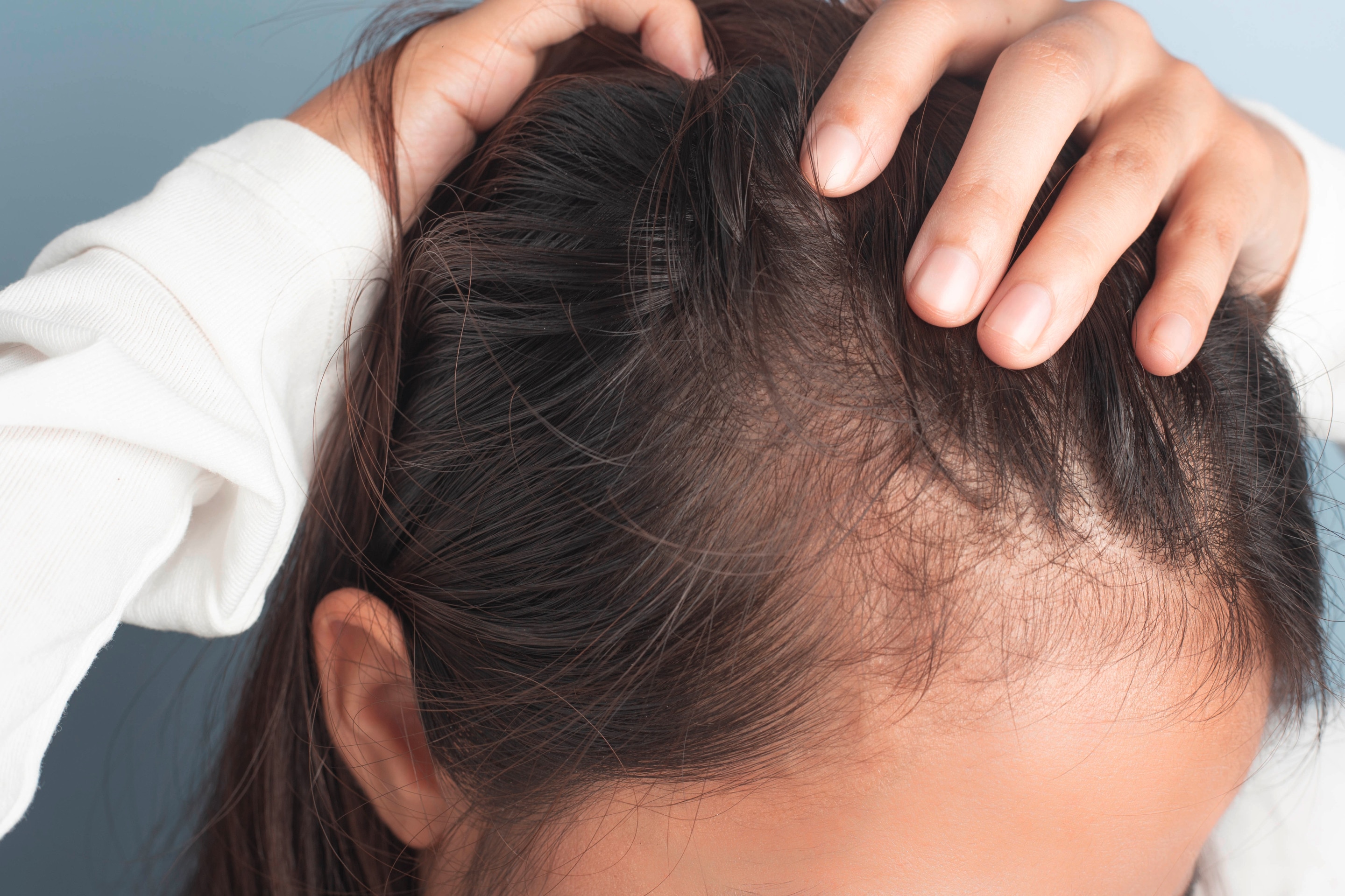 Close-up of a woman’s scalp.