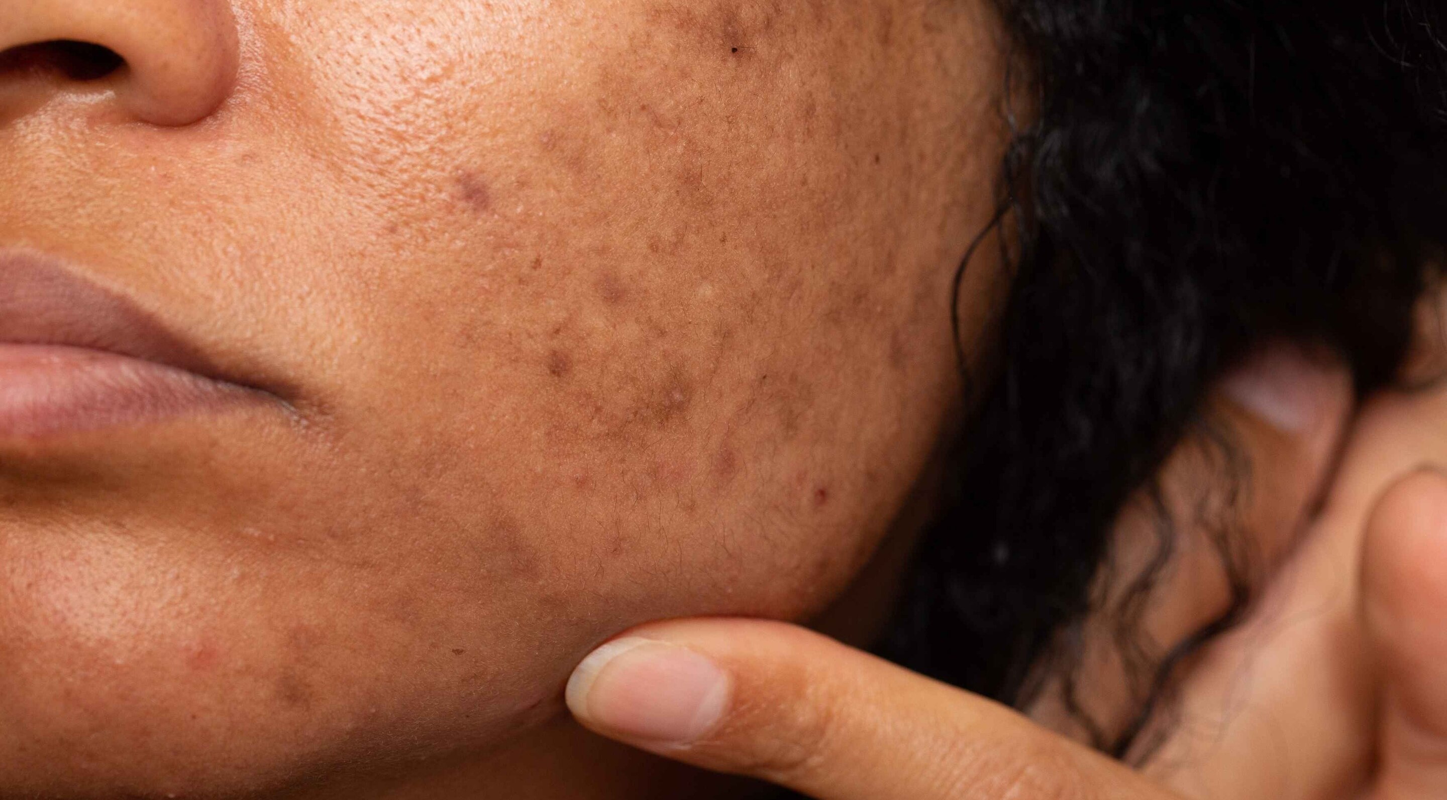 What Is Pigmentation (And Why Does It Happen)