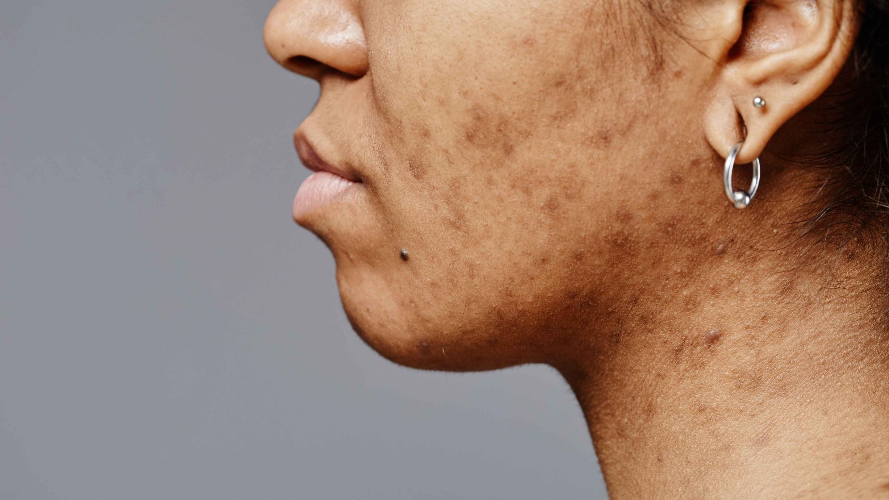 Image of Home Remedies for Pigmentation: Natural Ways to Remove Dark Spots Permanently