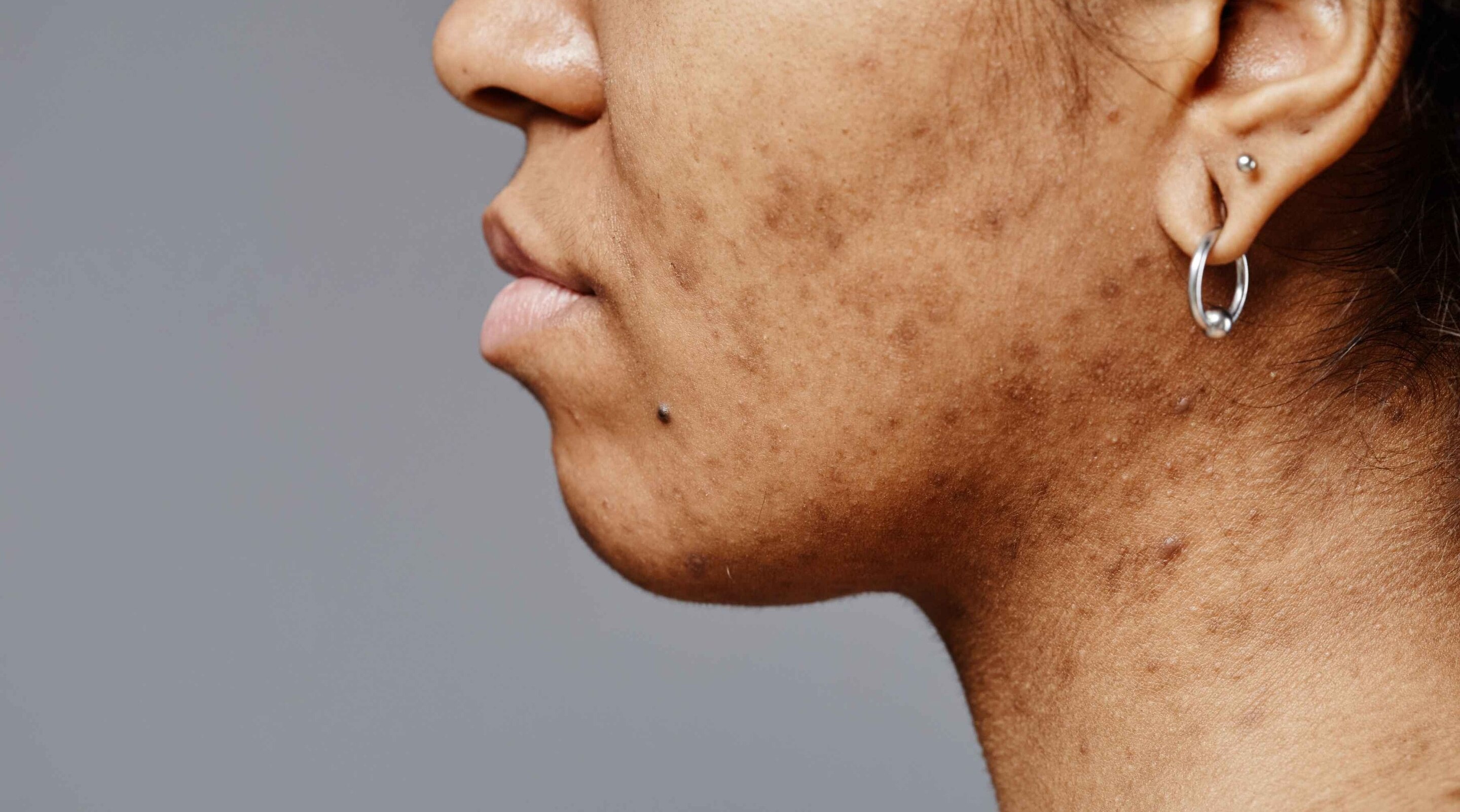 Home Remedies for Pigmentation: Natural Ways to Remove Dark Spots Permanently