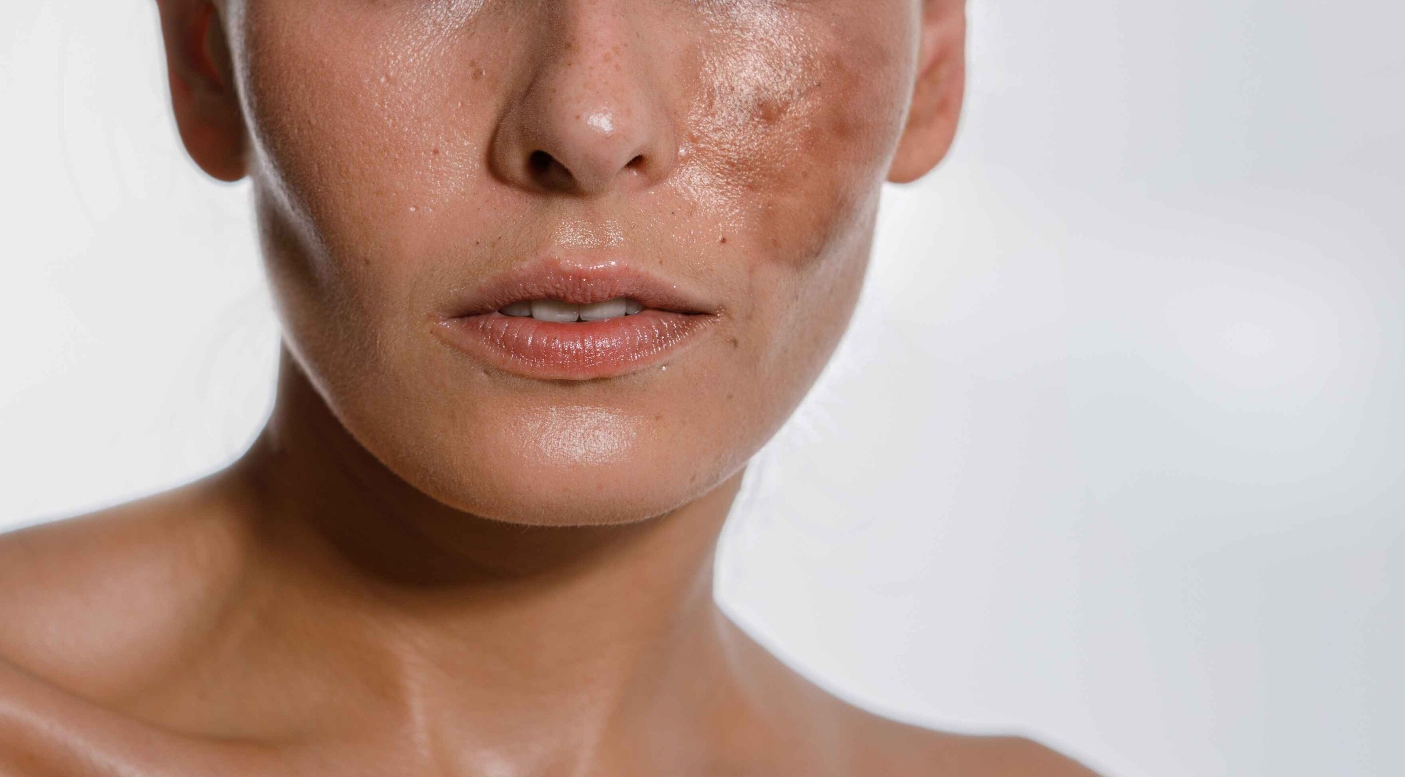 Pigmentation Reduction