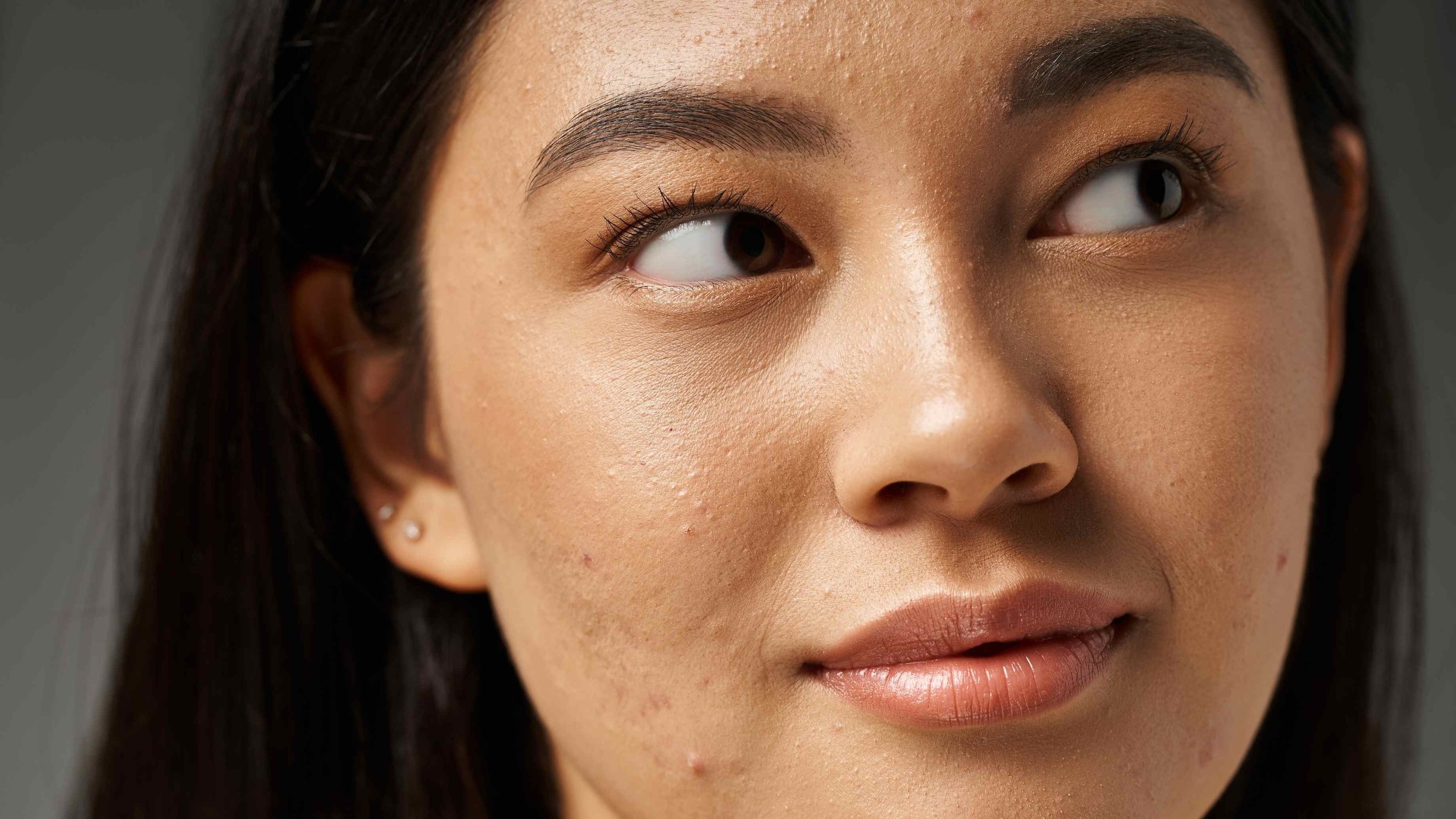 What Causes Pimples and Why Fast Treatment Matters