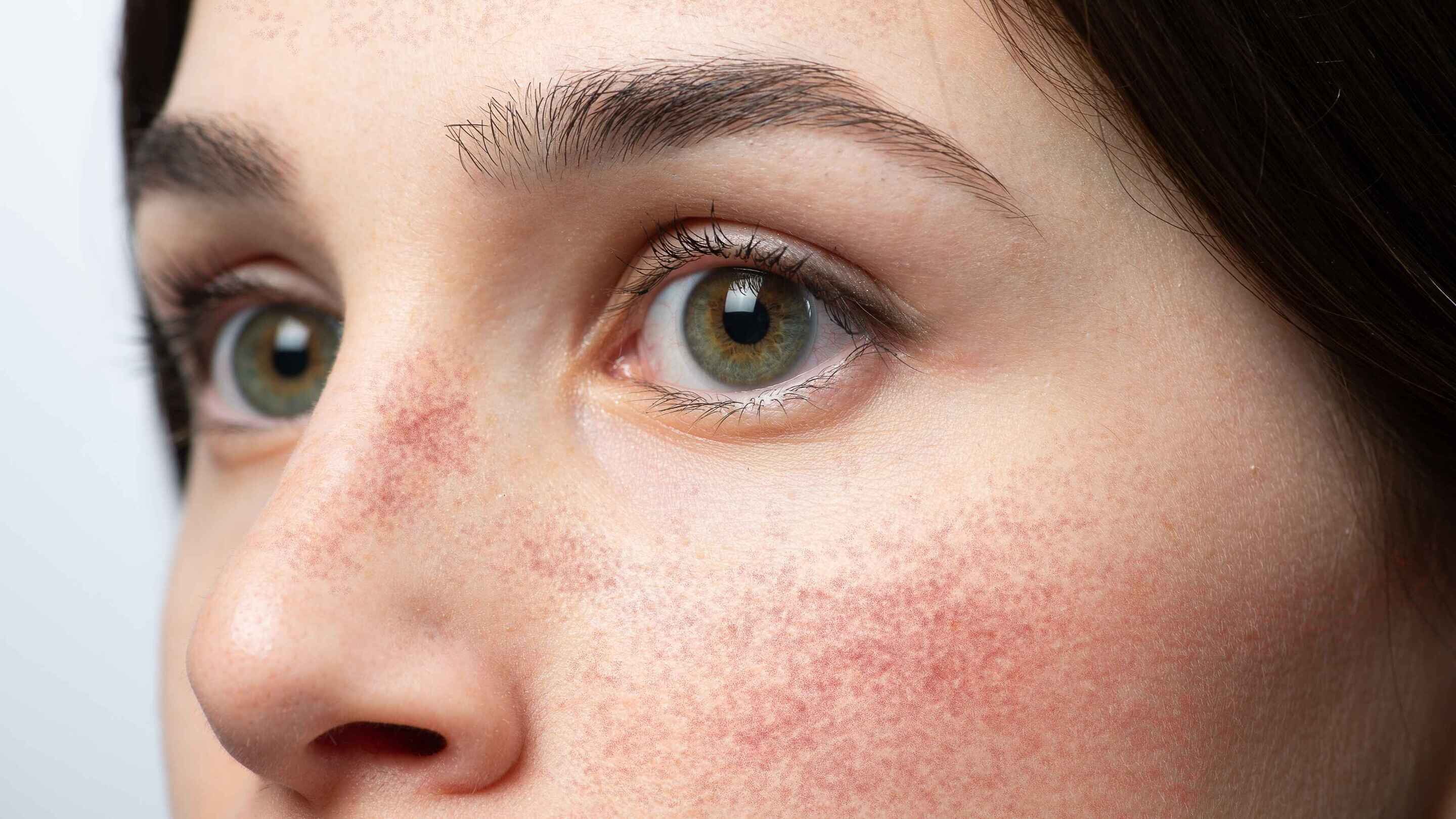 Glycolic Acid Side Effects  &amp; How to Use It Safely