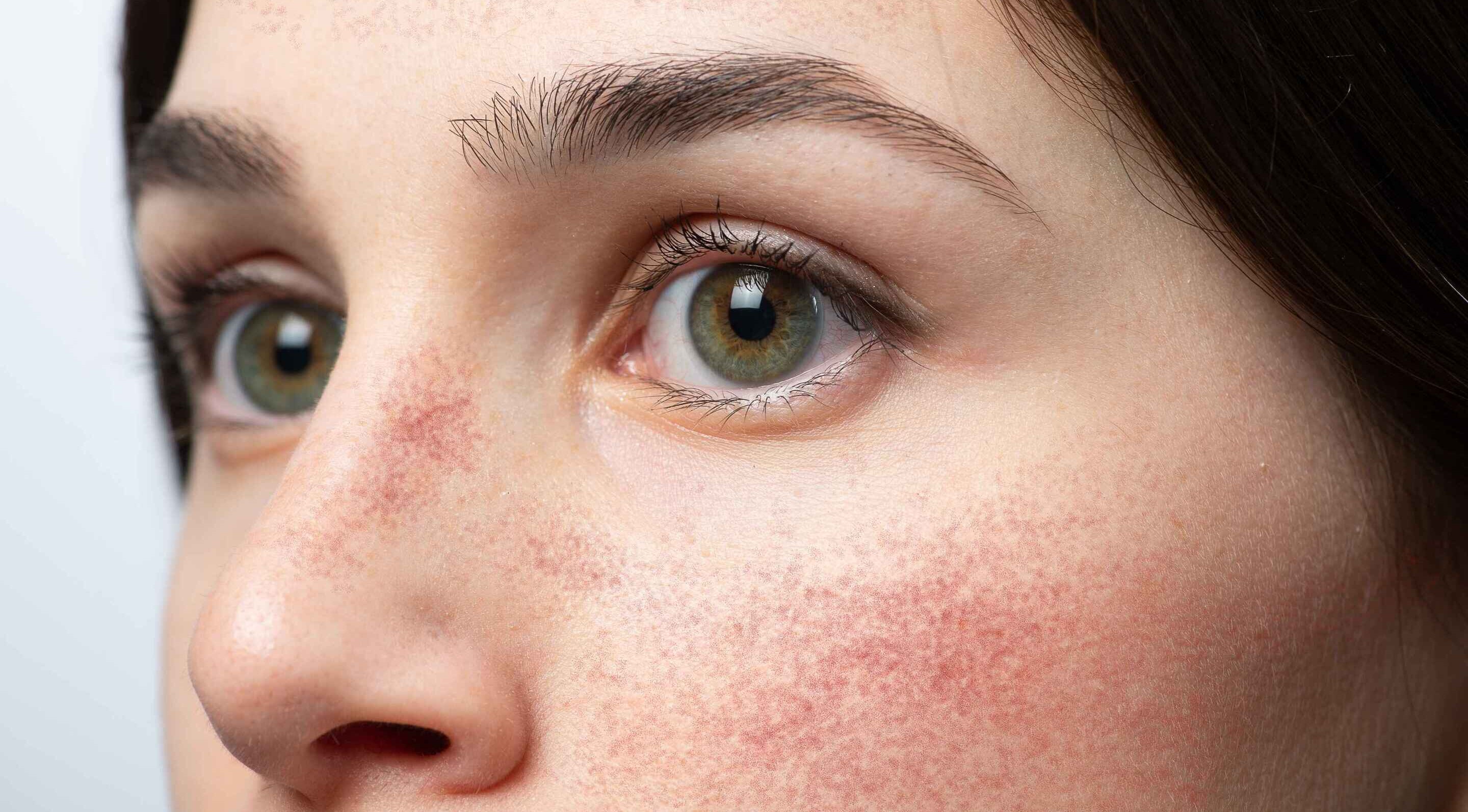 Glycolic Acid Side Effects  &amp; How to Use It Safely