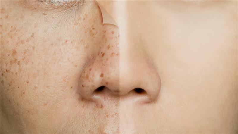 fades-dark-spots-img