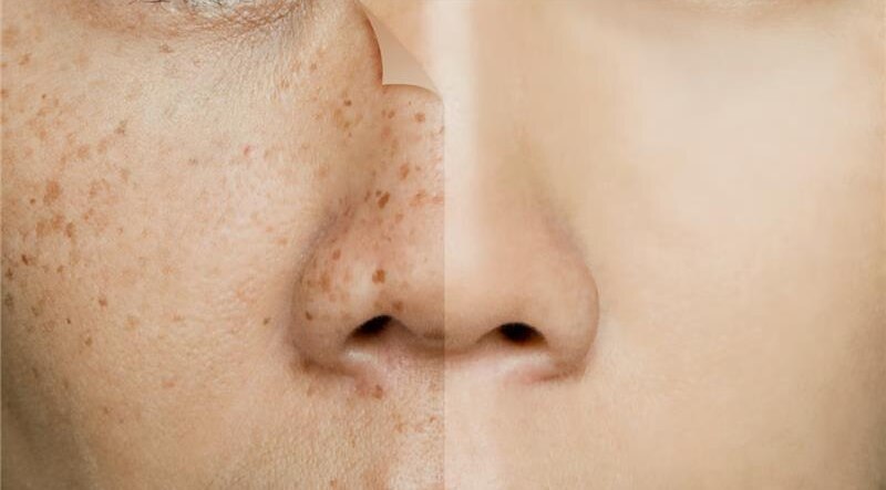 fades-dark-spots-img