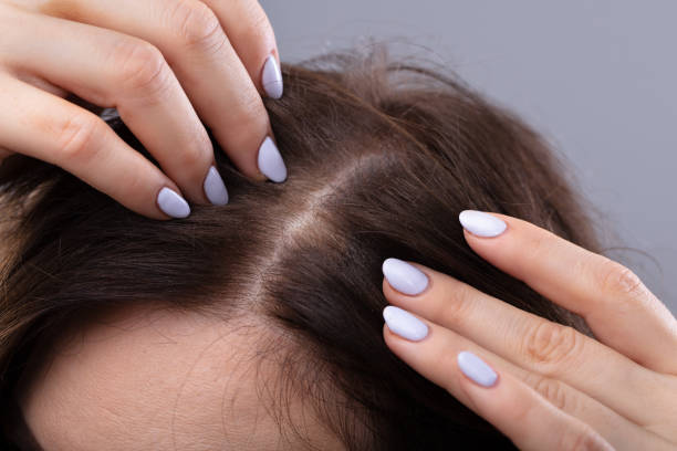The Link Between Hair Fall and Scalp Health