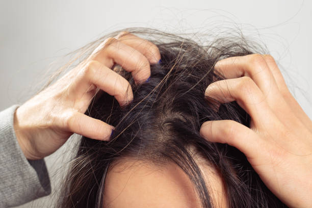 The Link Between Hair Fall and Scalp Health
