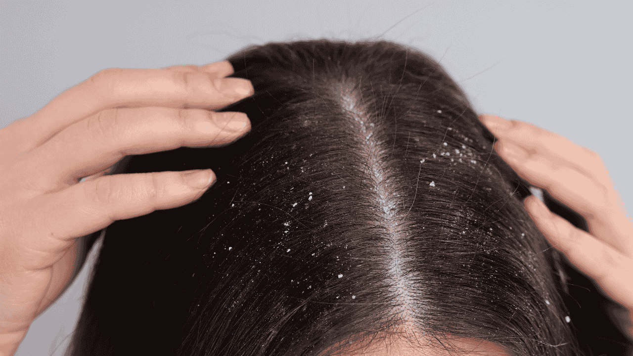 4. Reduces dandruff 