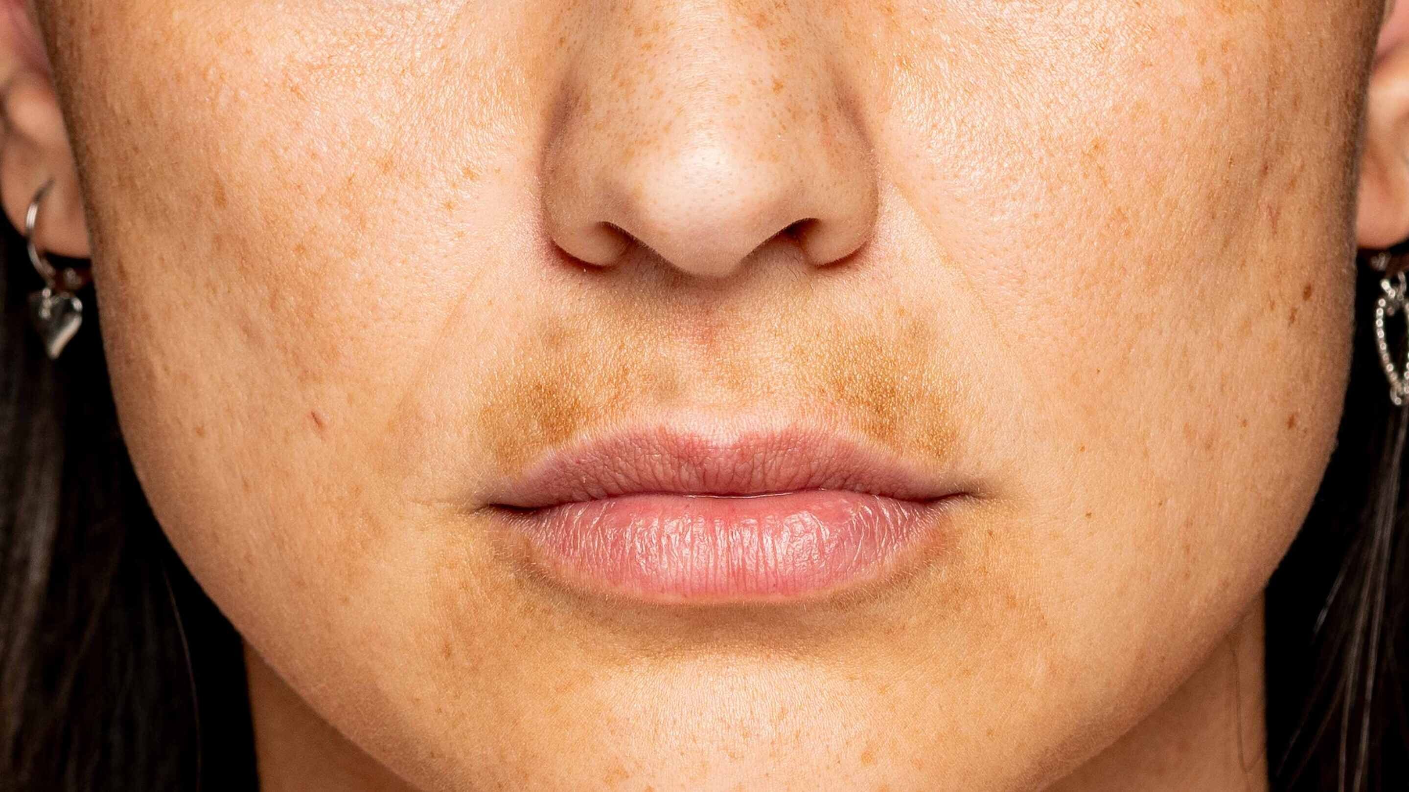 Reduces discolouration