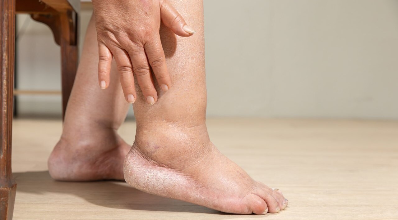 8. Reduces edema effect