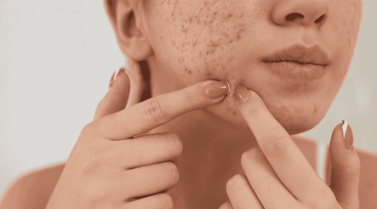 Fights Acne
