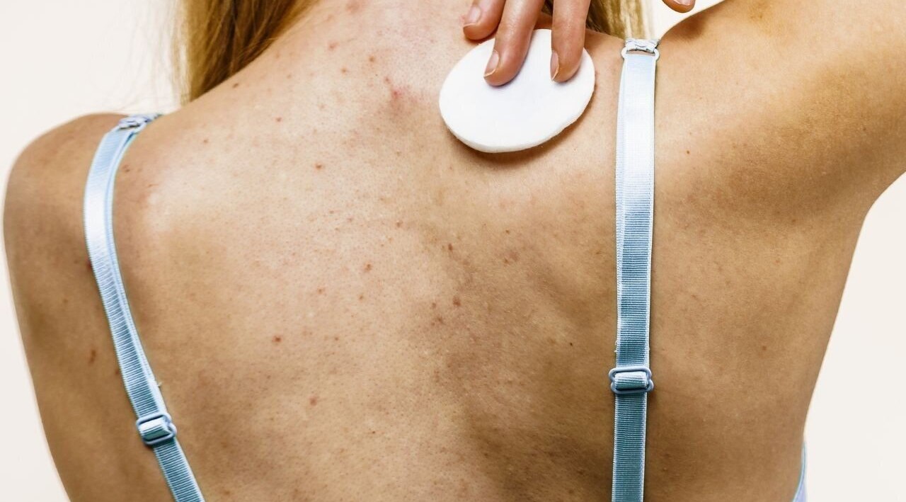 How to identify fungal acne