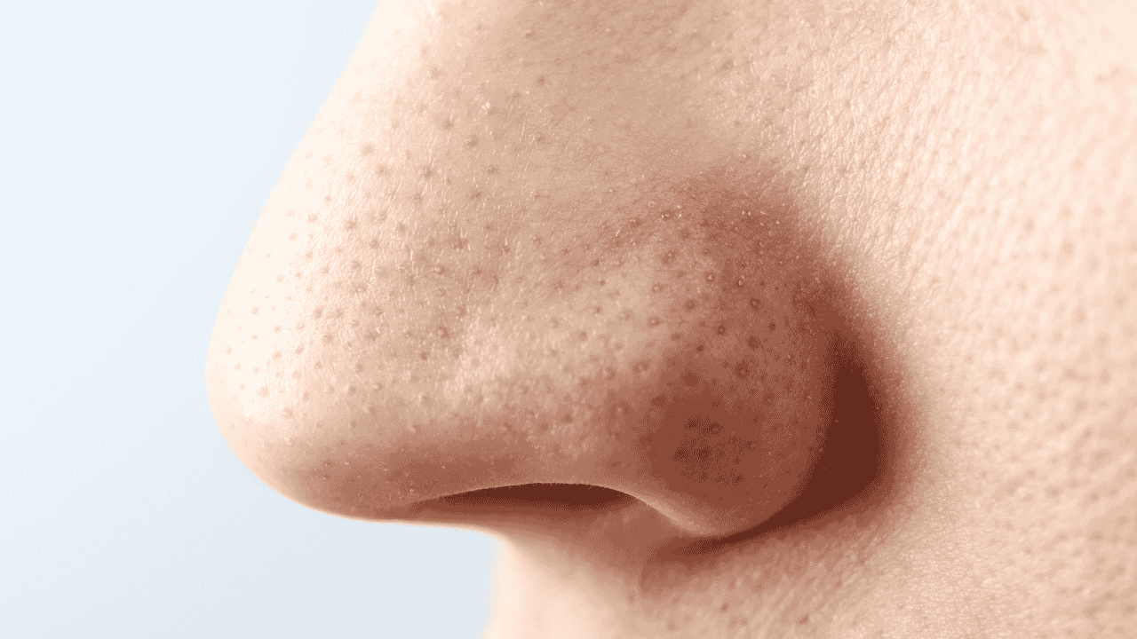 3. Activated charcoal fights blackheads 