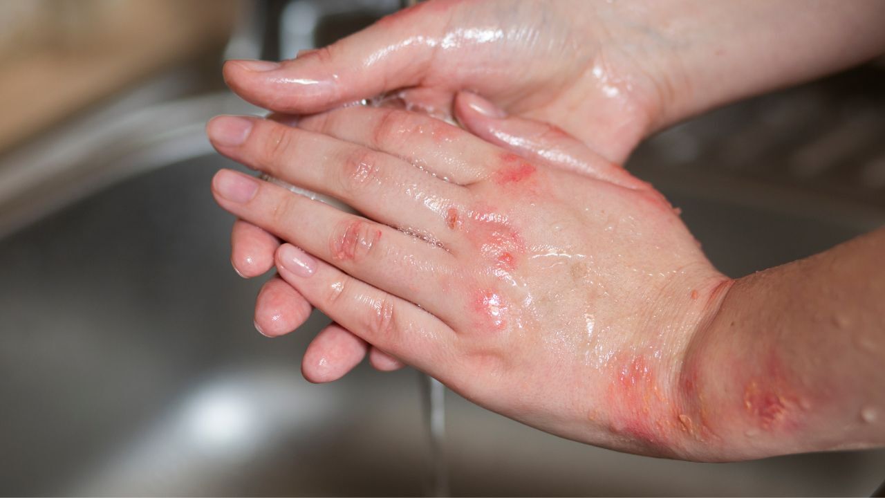 - Treats psoriasis and eczema