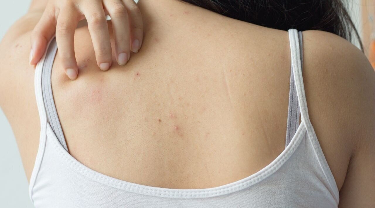 FAQs about fungal acne treatment