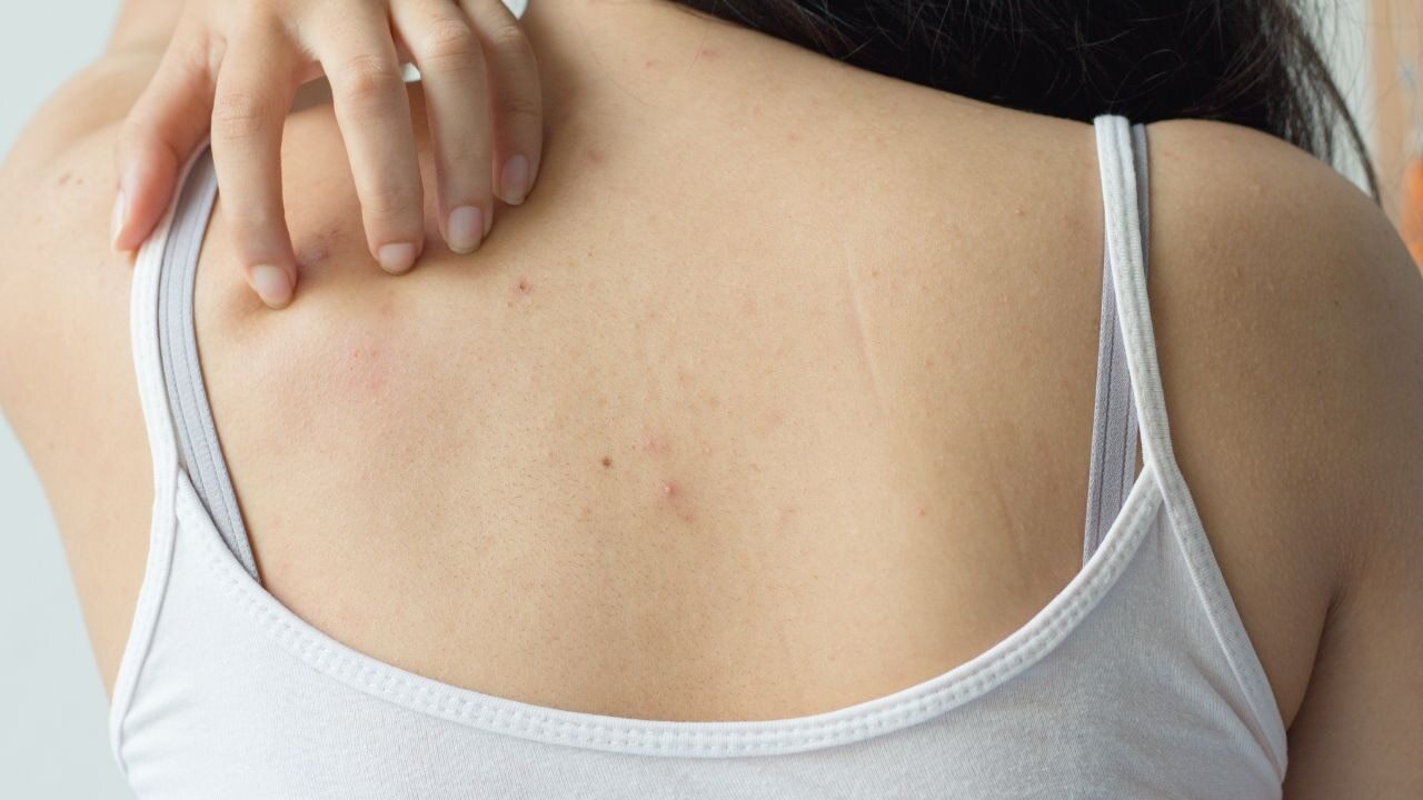 FAQs about fungal acne treatment