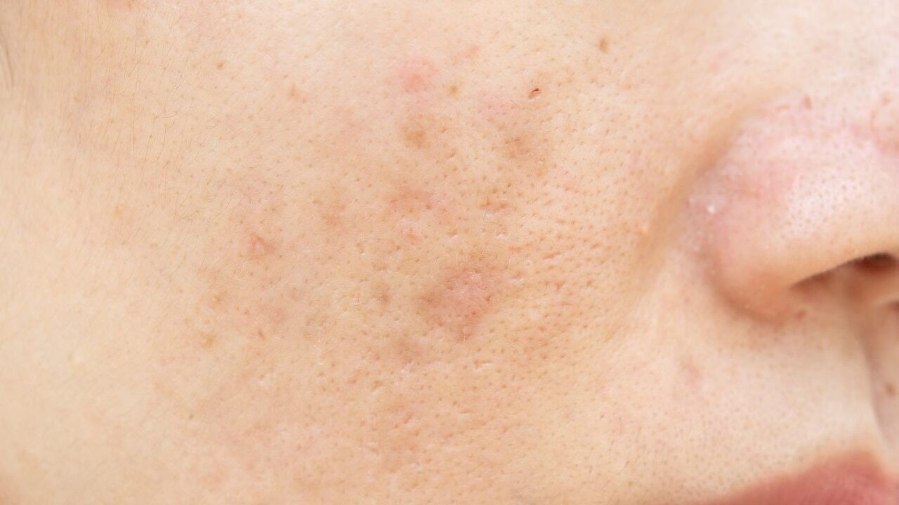 Black peel off masks - Reduces pore size