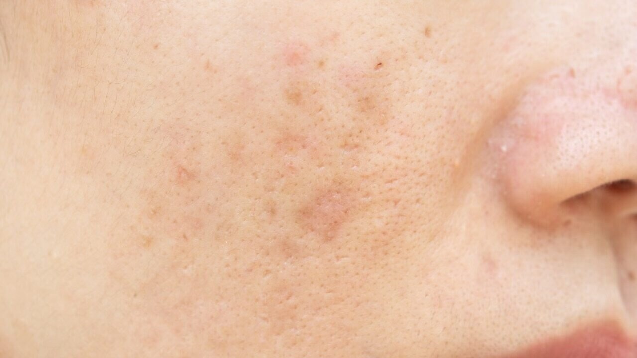 Black peel off masks - Reduces pore size