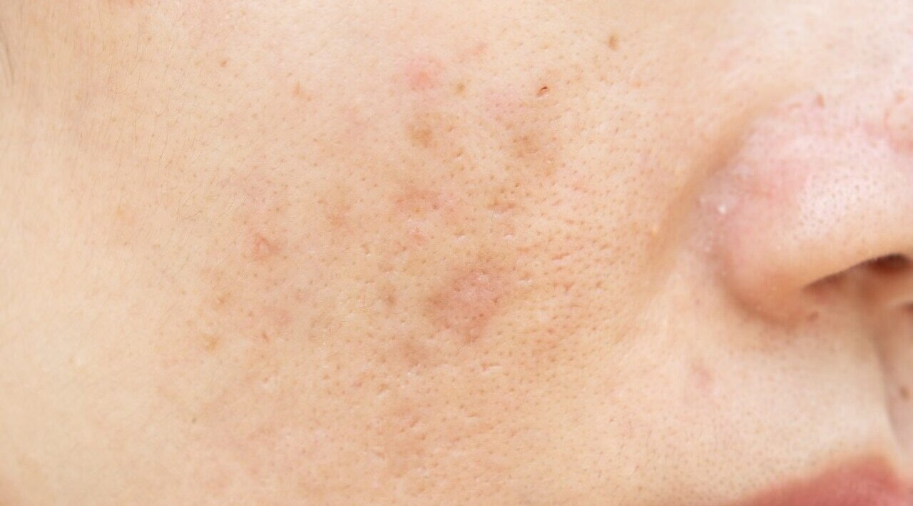 Black peel off masks - Reduces pore size