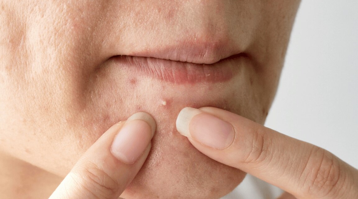 Do Eggs Cause Acne? Here Are 3 Reasons That Answer Your Question