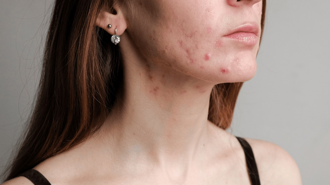 Damp skin creates an ideal environment for yeast overgrowth