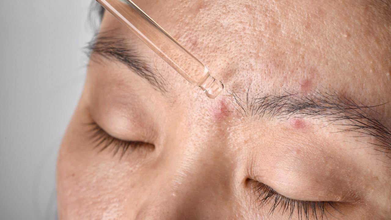 4. It Promotes The Healing Of Acne Scars