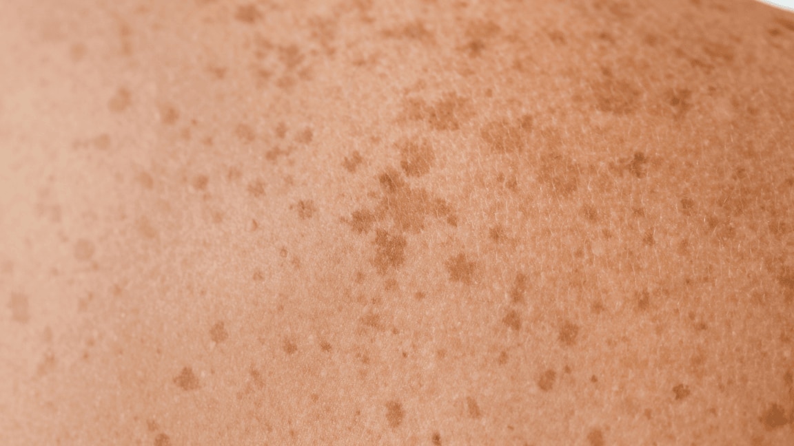 9 Expert Home Remedies For Freckles On The Face