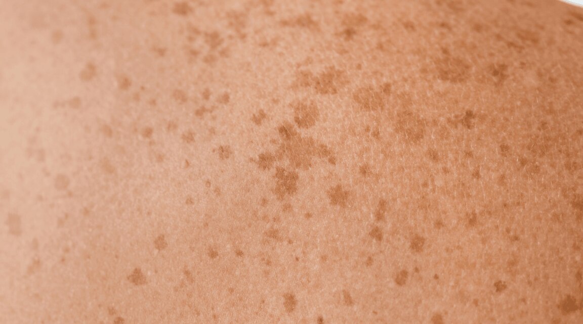 9 Expert Home Remedies For Freckles On The Face