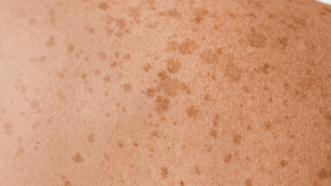 9 Expert Home Remedies For Freckles On The Face