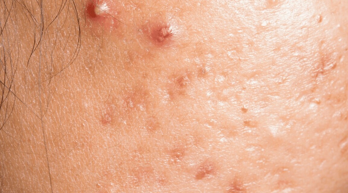 Here’s Everything You Need To Know About Doxycycline For Acne