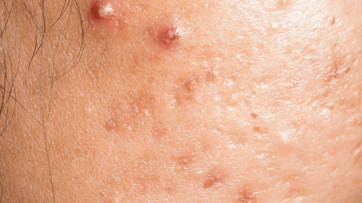 Here’s Everything You Need To Know About Doxycycline For Acne