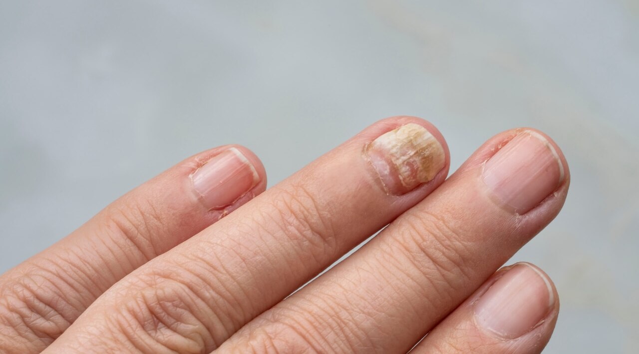How to Prevent Fungal Infections?
