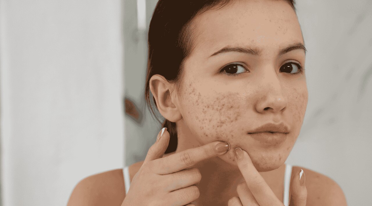 Prevents Acne, Pimples and Breakouts