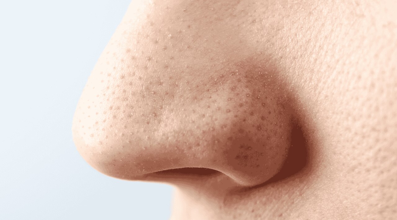 Reduces Blackheads and Whiteheads