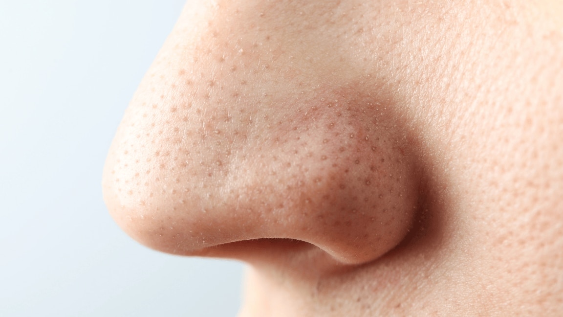 Homemade Scrub for Blackheads : Natural & Effective DIY Remedy