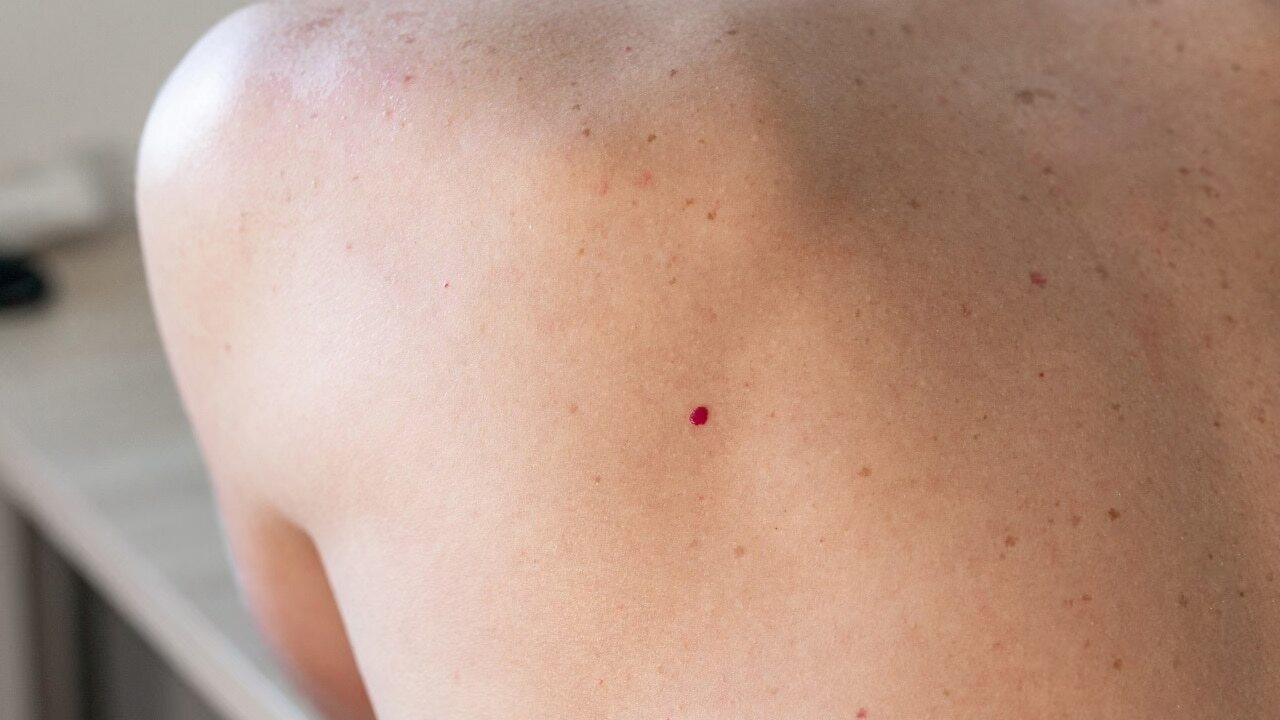 What are the side effects involved with removal of cherry angiomas?