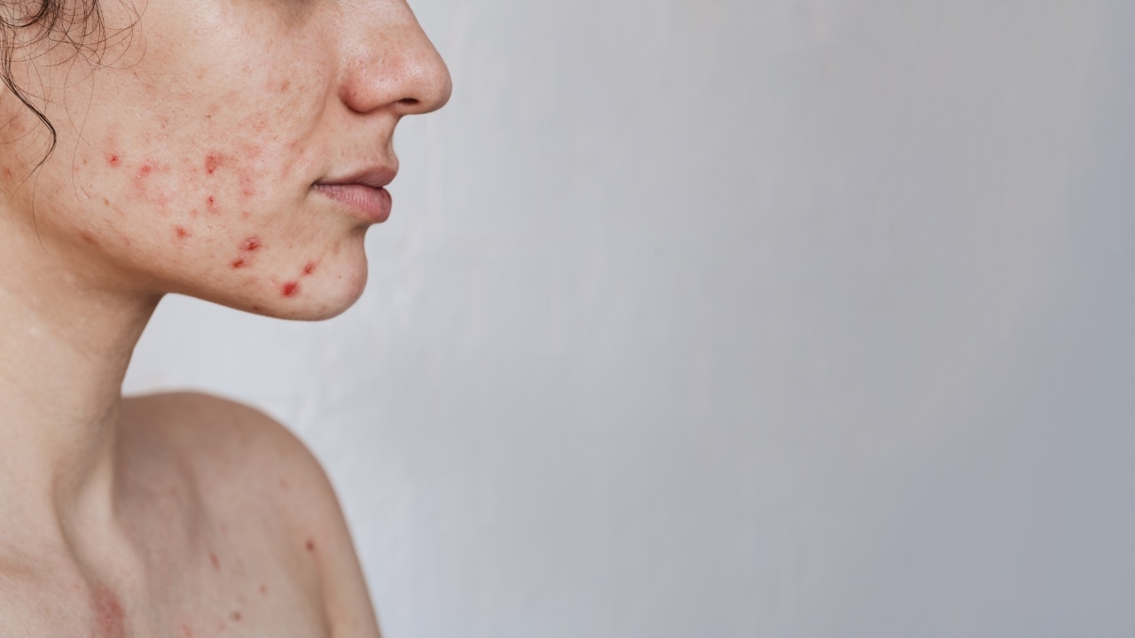 What is doxycycline and how does it help with acne