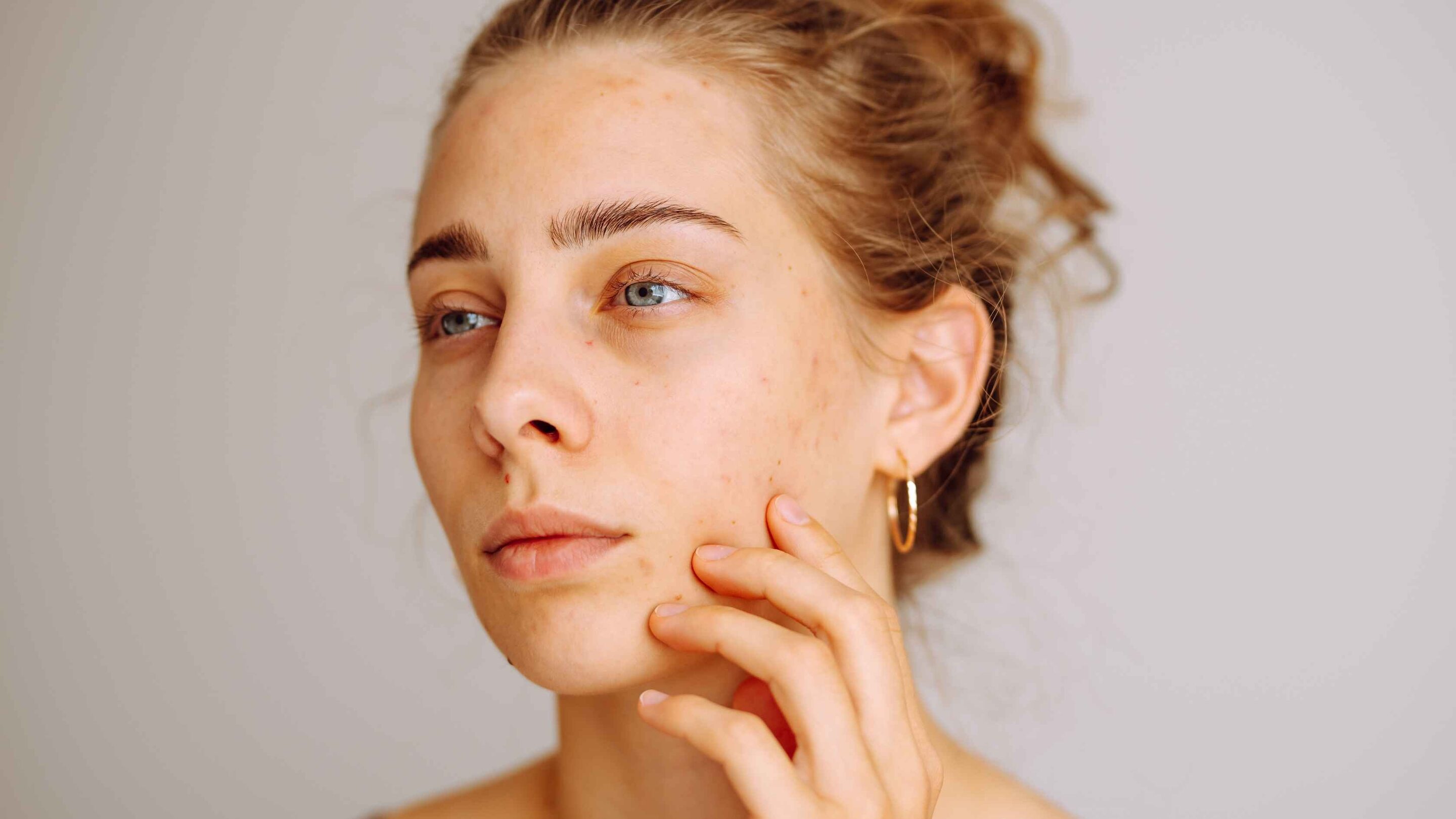 Why you could get facial dandruff