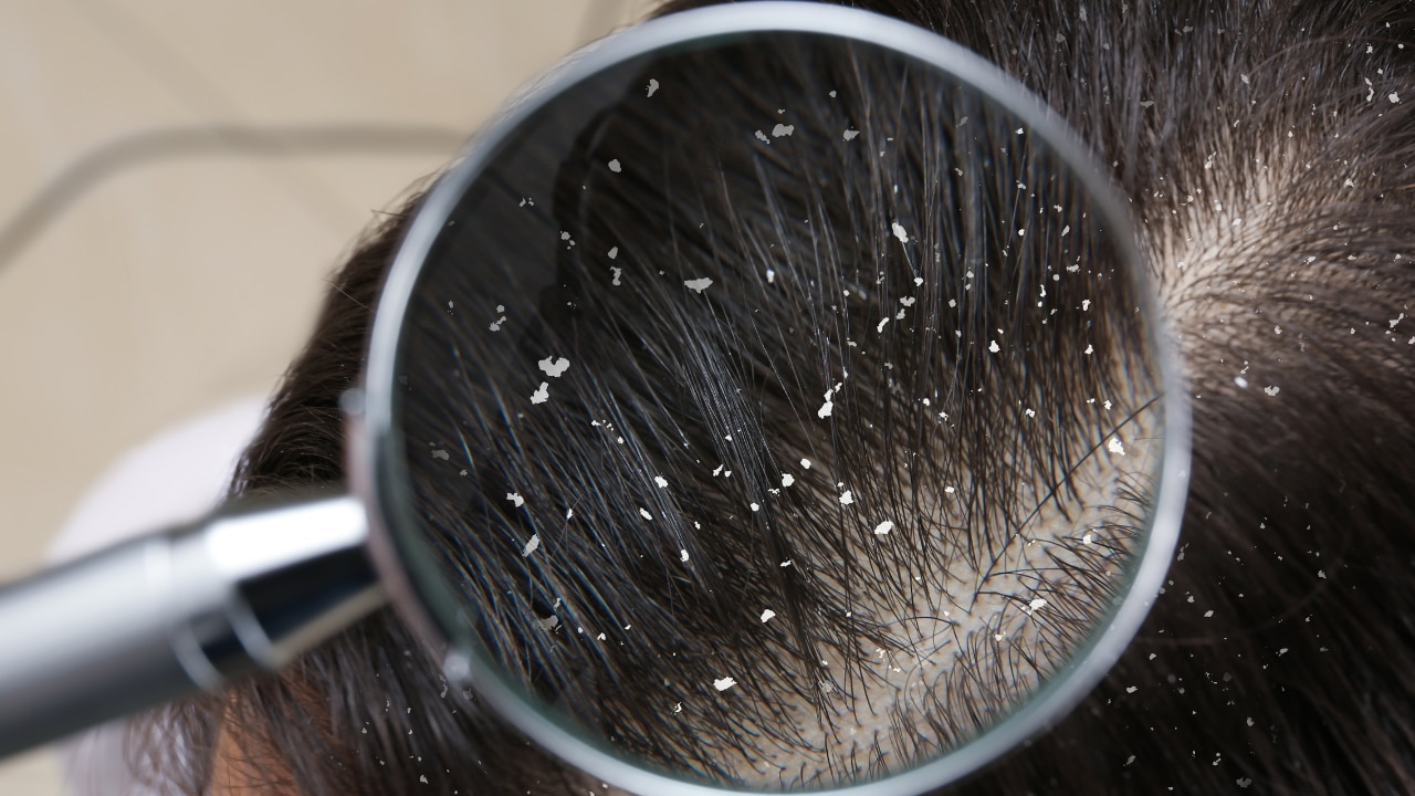 Keeps dandruff and itchy scalp at bay