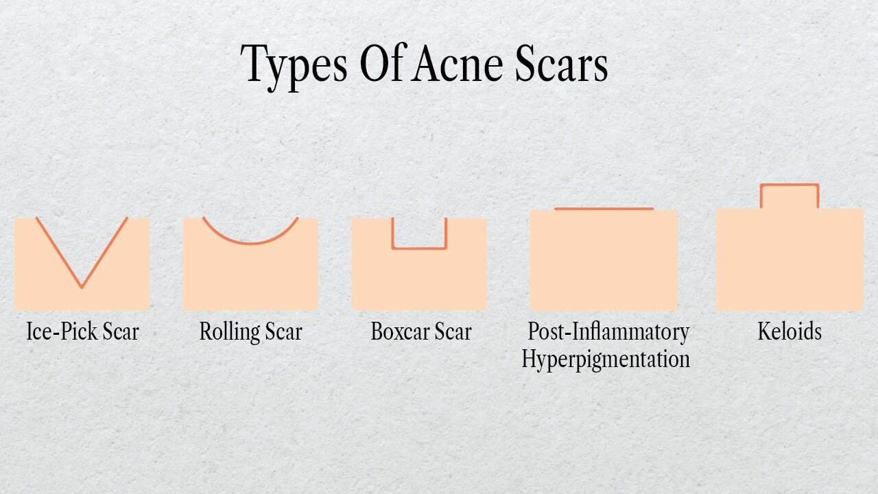 Types of pimple marks