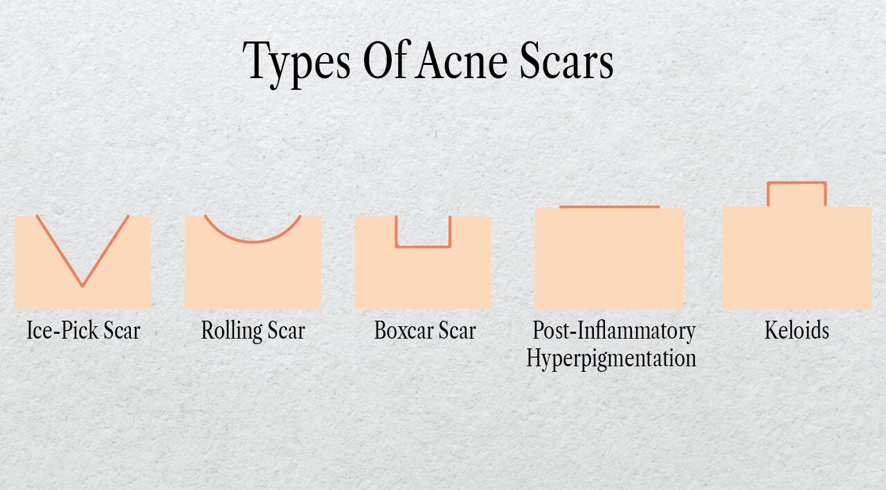 Types of pimple marks