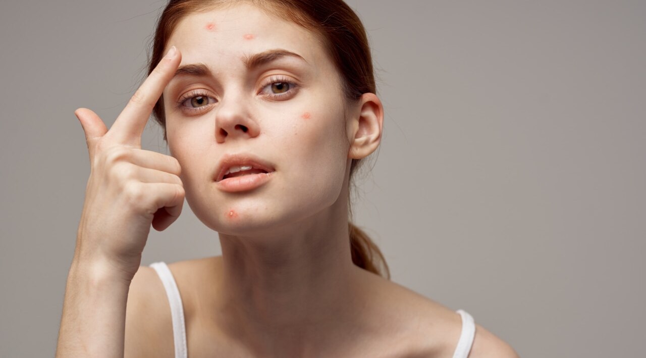 Can pimples and acne make your skin feel itchy