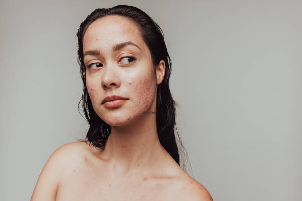 Surprising Causes Of Adult Acne And How To Get Rid Of It