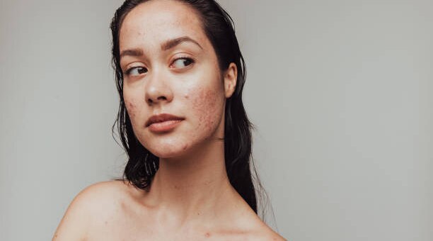 Surprising Causes Of Adult Acne And How To Get Rid Of It