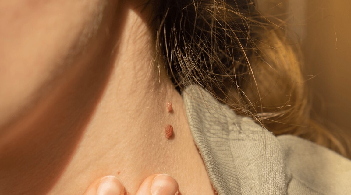 You Need To Try These Simple And Quick Home Remedies For Treating Skin Tags