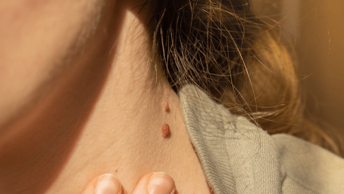 You Need To Try These Simple And Quick Home Remedies For Treating Skin Tags