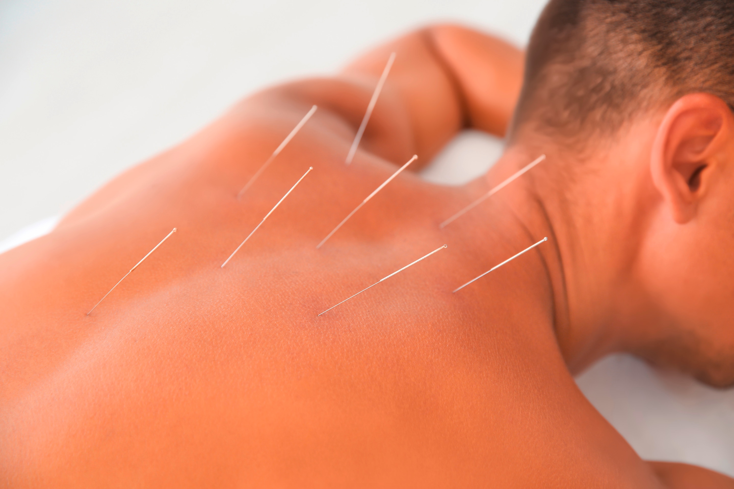 A photo of acupuncture needles on a man’s back.